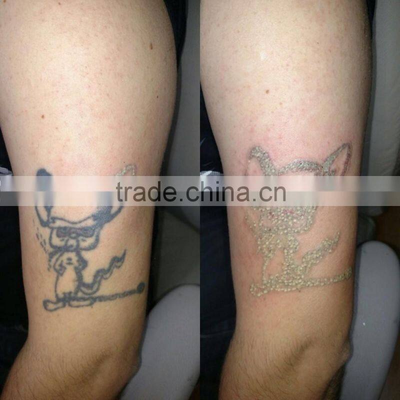 Newest generation q switch nd yag removal machine tattoo laser with CE