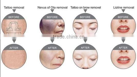 Professtional 1064nm 532nm electronic-optical nd yag laser tattoo removal system