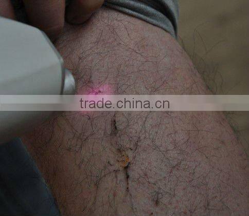 Medical laser hair removal machine for sale