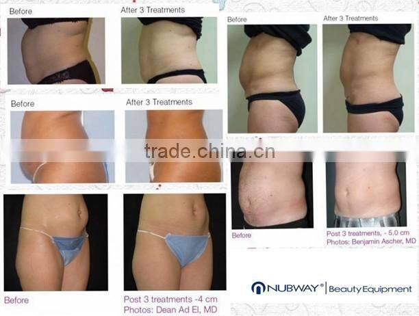 professional slimming machine hifu fat reduction system