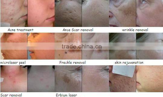 High Power professional 2940nm er yag laser scar removal machine