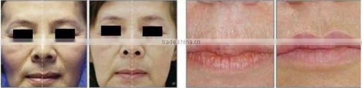 Top technology vaginal tightening RF CO2 fractional laser beauty machine factory price OY-11