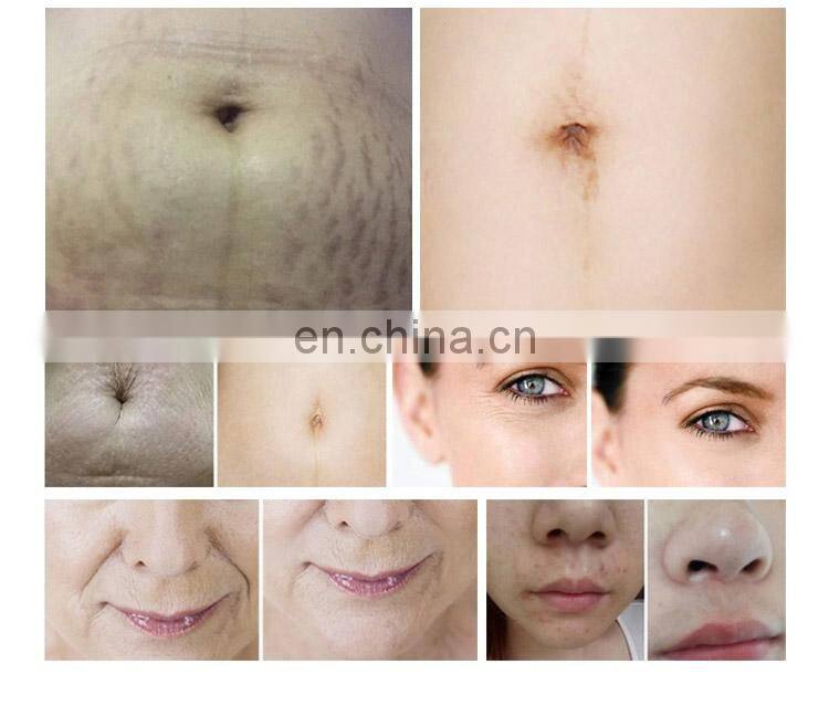 2019 New Fractional RF microneedle System Skin Tightening Machine Anti-wrinkle Stretch Mark Removal Facial Rejuvenation
