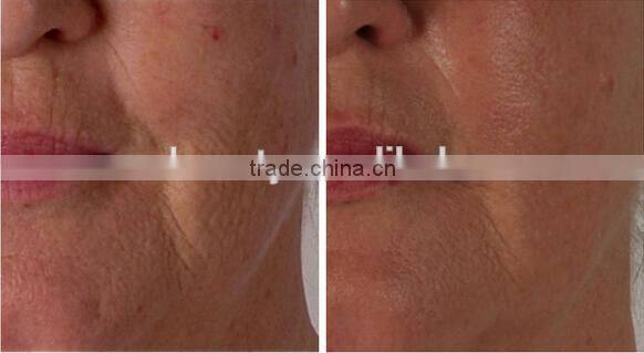 2016 hot 1200 needles body roller 3in1 derma cosmetic roller kit for dermatology