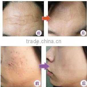 3 in 1 Multifunctional Elight(IPL+RF) with yag laser Beauty Equipment