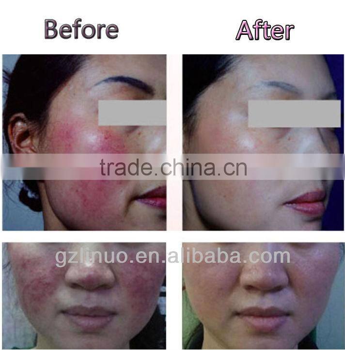 Portable High Frequency Blood Vessels Removal Device