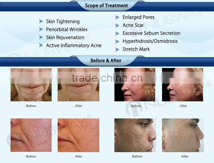 professional laser level micro needle fractional rf