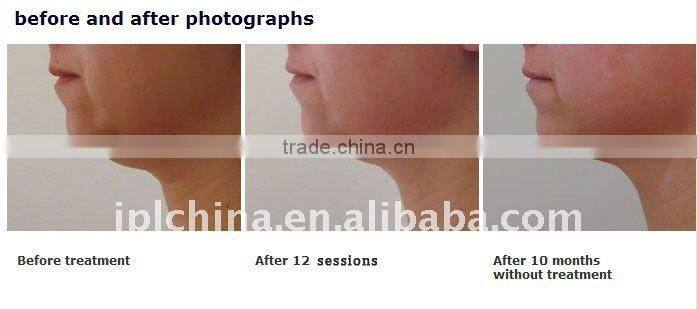 Doublo RF Cavitation Vacuum Slimming Machine