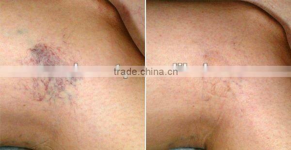 Jiatailonghe salon use nd yag laser hair removal machine for beaury salon use