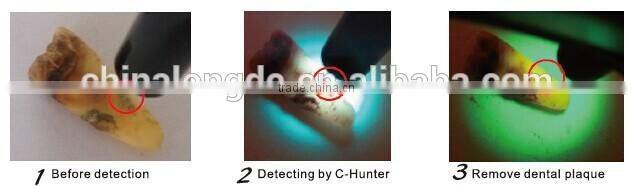 Dental wireless caries detector C-hunter