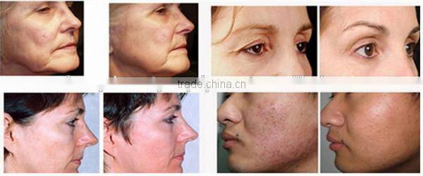 2015 hot selling radiofrecuencia rf portable equipment