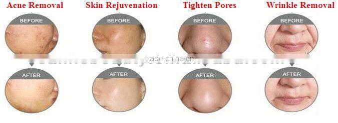 Professional hot products cheap price co2 laser face lift machine