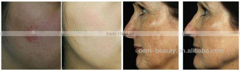 Personal Pain Free Nd Yag laser hair remover and onychomycosis removal