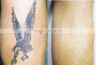 Q-switched ND: YAG laser, laser tattoo removal machine price for eyebrow removal skin rejuvenation -D003