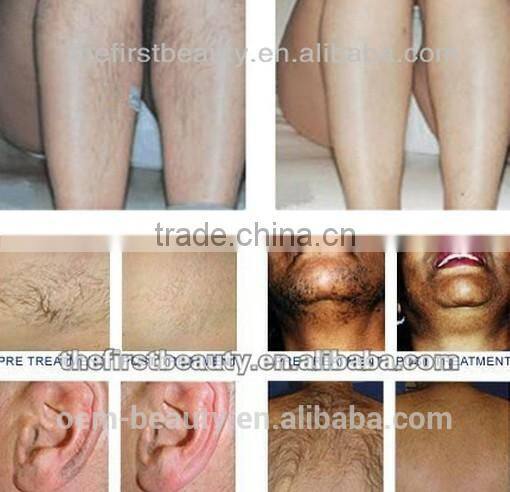 Top diode laser hair removal /laser diode 808/laser machine for hair removal
