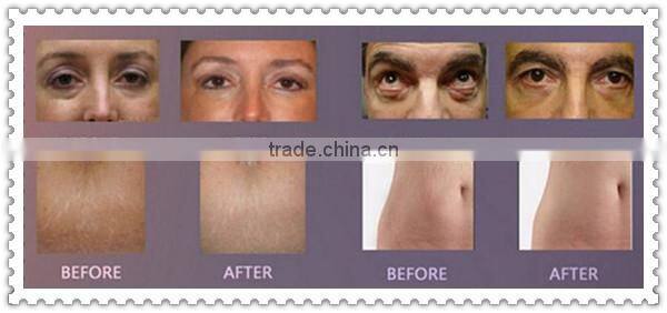 Micro needle wrinkle removal beauty machine