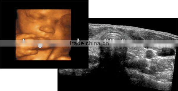 Medical color doppler Ultrasound Diagnostic System, color doppler ultrasound