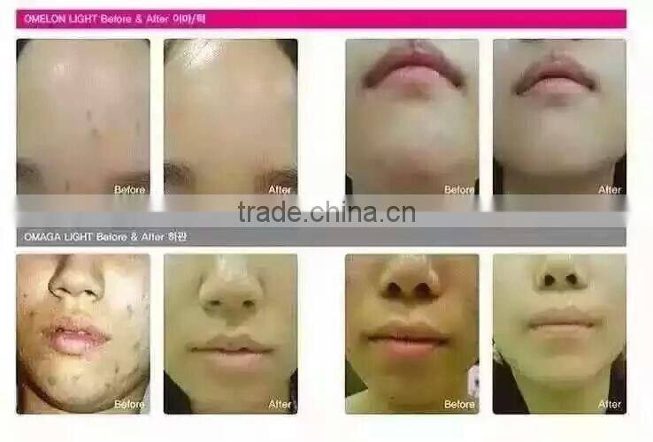 Omega light color therapy equipment PDT machine