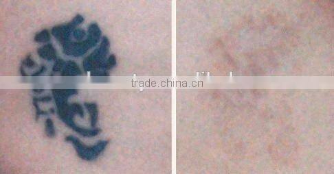 No side effective & safety using nd yag q switch laser tattoo removal machine/laser beauty equipment with Lowest price -D006