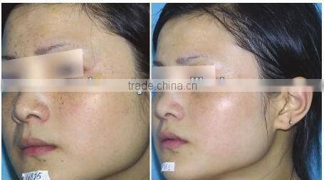 Latest Multi-functional IPL machine for hair reomval treatment with operation video (FB-AP-TK)