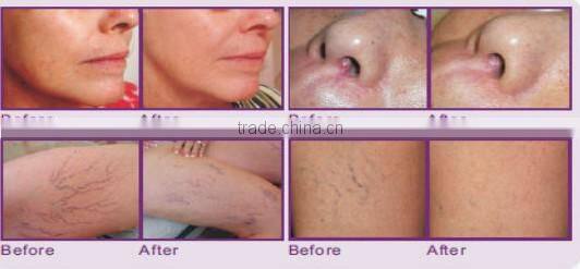 808nm diode vacuum shockwave therapy vacuum slimming machine