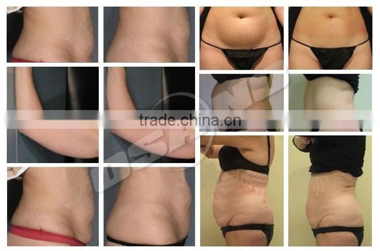 Multifunctional Beauty Salon Medical With Lipo Laser Machine