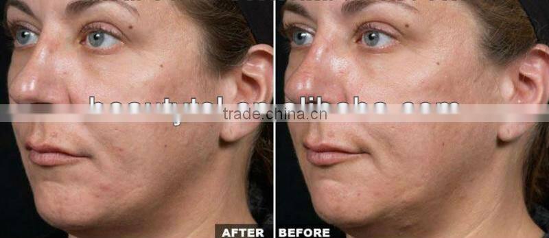 Fractional rf facial microneedle rf fraction machine,Adjustable penetration depth&Adjustable RF treatment output energy