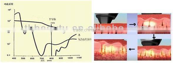 10.000.000 shot laser hair removal eyebrows