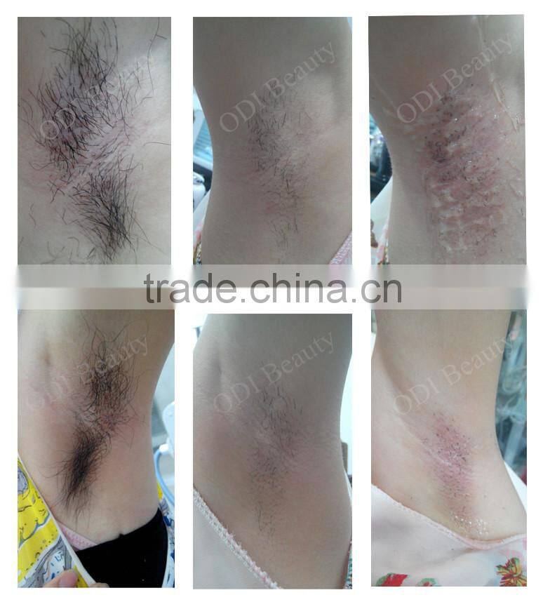 OD-E70 Newest!! 2-IN-1 opt-e light Skin Beauty System Best For Hair Removal & Skin Rejuvenation with CE Certificate