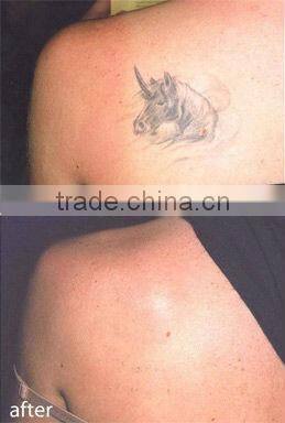 Good quality and competitive price of tattoo removal laser for sale D005