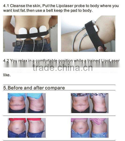 VY-L650 Lipolis Laser Assisted Lipo Dissolve Machine