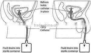 Henso 2-way Female Latex Foley Catheter