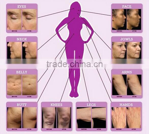 Best RF Skin Tightening Face Lifting Machine MultiShape Mini