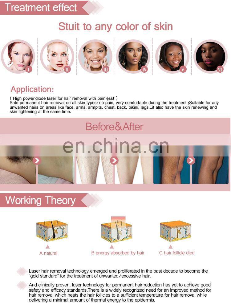 Alibaba Express Turkey Diode Laser Hair Removal