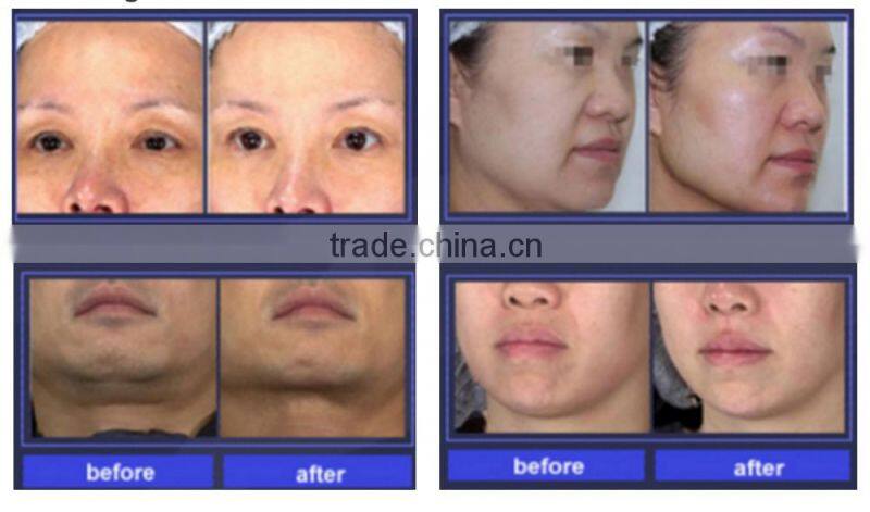 SK-730 Hi-Fu High Intensity Focused Ultrasound