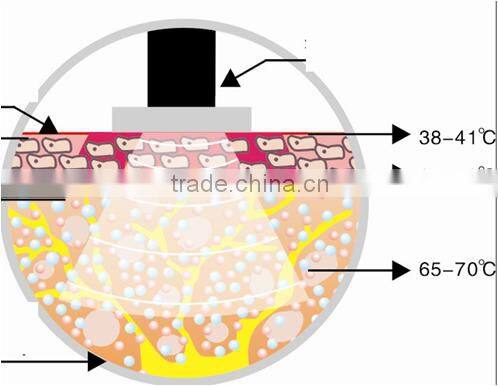 Factory direct selling Low price RF machine skin tightening face lifting ZOEY