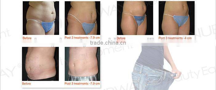 New Product High Intensity Focus Ultrasound HIFU for body slimming