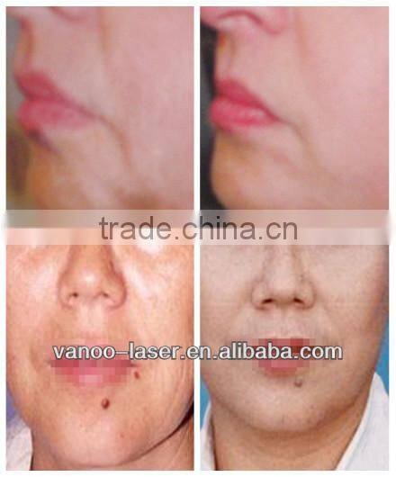 skin tighting radio frequency rf machine