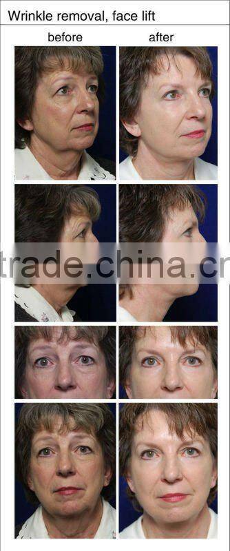 High quality ipl/rf hair removal machine with factory price