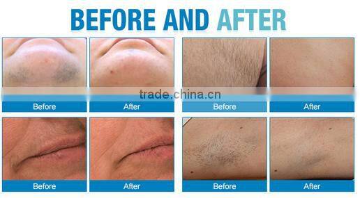 IPL upgraded skin rejuvenation hair removal 2000w machine