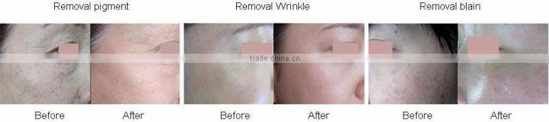 Newest home microdermabrassion fractional machine