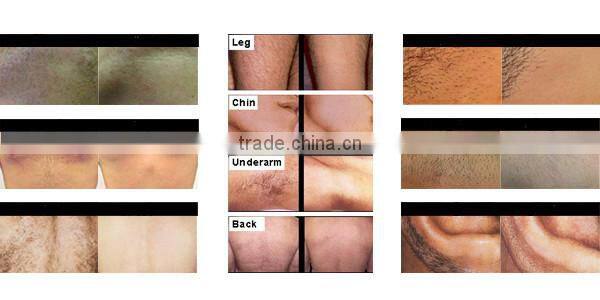 Newly designed most advanced professional vertical 808nm diode laser hair removal skin spa medical device