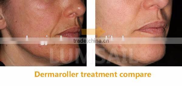 0.2 to 3.0mm micro needle derma roller 540 Titanium derma roller