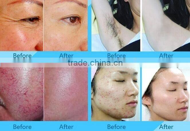 new products looking for distributor ipl beauty machine for home laser hair removal