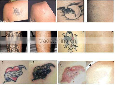 Strongest powerful 2014 Distributor prices CE approved amazing results qmini tattoo removal laser machine
