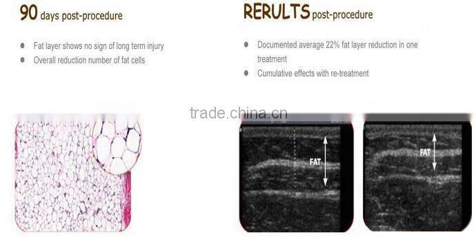 CE Certificated cryotherapy equipment Cavitation & RF & lipo laser Cryolipolysis lipo machine with teaching video