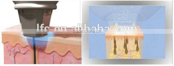 LFS-808C 2015 Newest! 808nm Diode Laser Hair Removal Machine/Supply OEM/ODM Spare Parts/Hand Piece