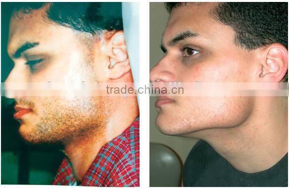 Vertical Multifunctional SHR hair removal machine