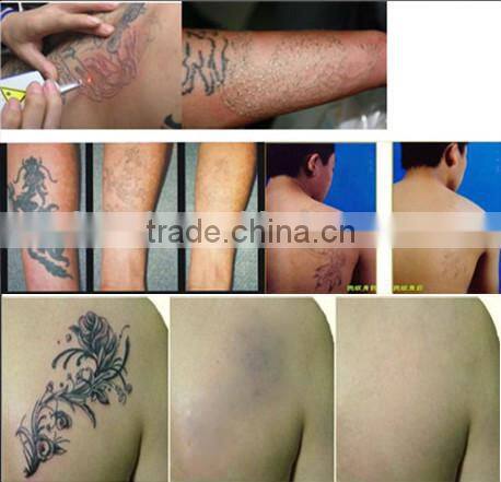 venus laser hair removal e-light ipl rf+nd yag laser multifunction machine laser epilation