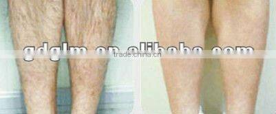 ipl machine photo skin rejuvenation